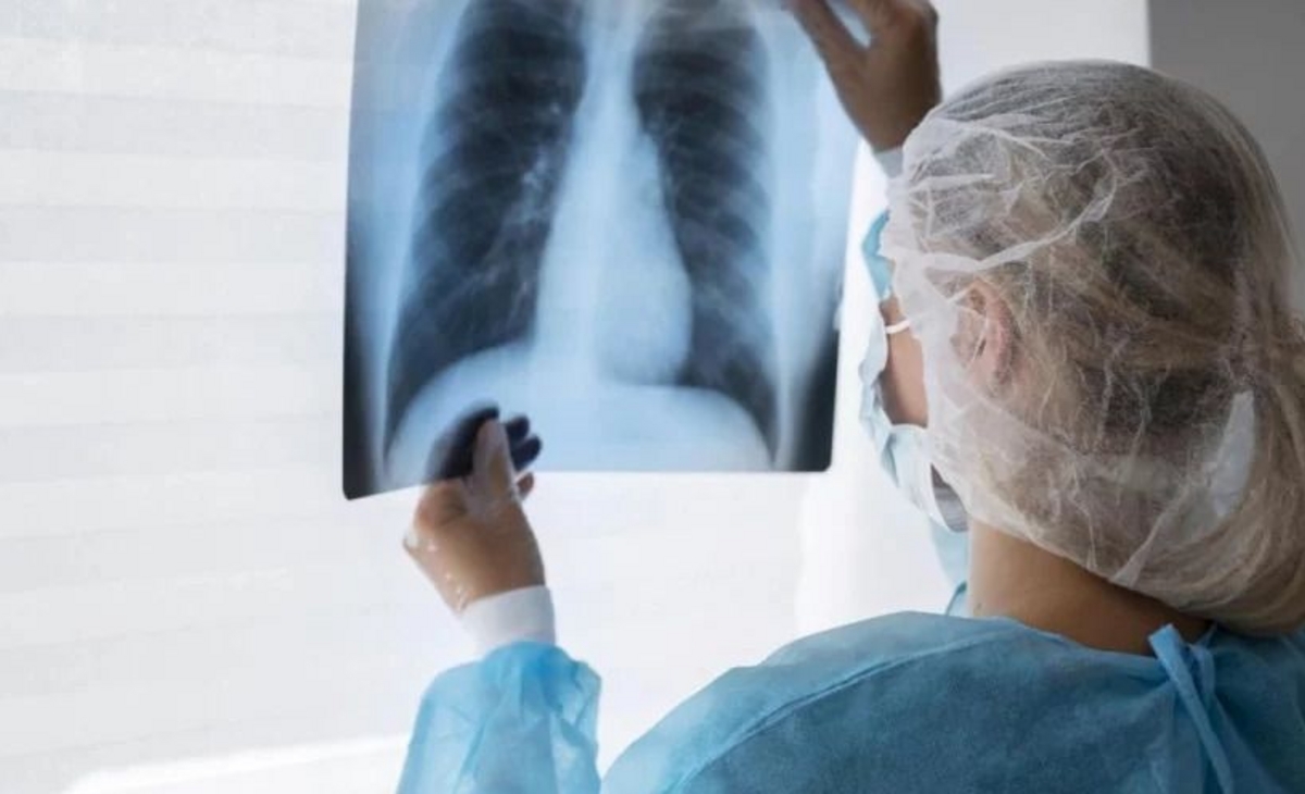 Alarmante aumento de casos de tuberculosis en Argentina: un llamado urgente a la atención